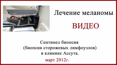 Сентинел биопсия в клинике Ассута. Видео