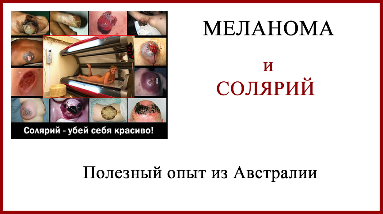 Меланома и Солярий. Полезный опыт из Австралии Меланома и солярий