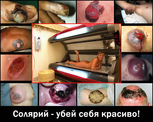 Меланома. Посещение солярия грозит вам очень большими неприятностями. Меланома. Посещение солярия грозит вам очень большими неприятностями.
