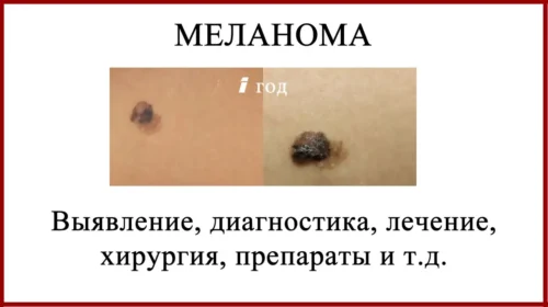 Меланома диагностика лечение. Всё о меланоме