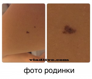 Родинка фото