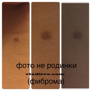 Фиброма фото