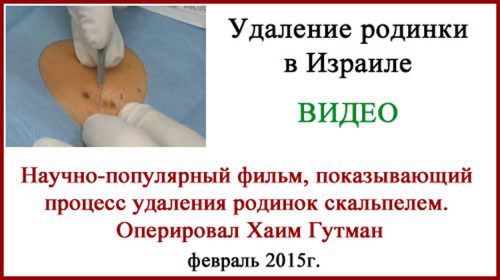 Удаление родинки в Израиле скальпелем. Фото и видео. Блог Дяди Вадика