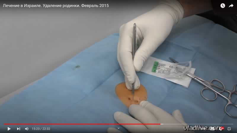 Удаление родинки в Израиле Видео