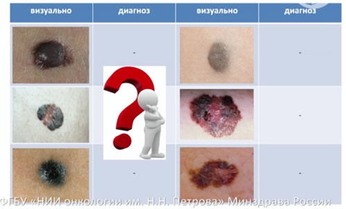 Меланома, или нет?