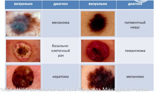Меланома. Дерматоскопия. Результаты. Лечение меланомы ошибки