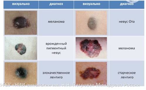 Меланома.