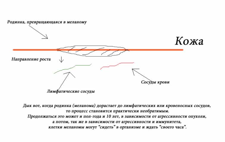 Как развивается меланома