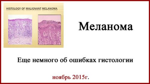 Пересмотр гистологического материала при меланоме кожи