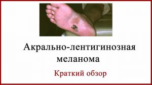 Акрально-лентигиозная меланома Блог Дяди Вадика