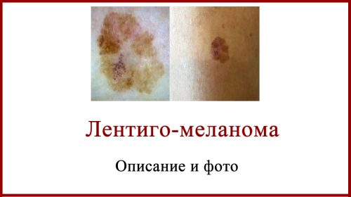 Лентиго-меланома описание фото