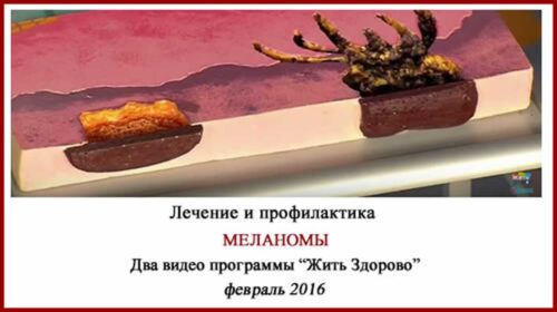 Лечение меланомы Елена Малышева