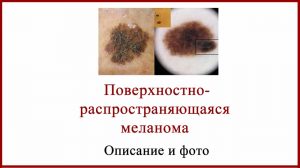 Поверхностно распространяющаяся меланома