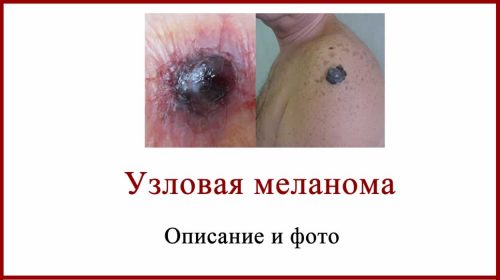 Узловая меланома описание фото