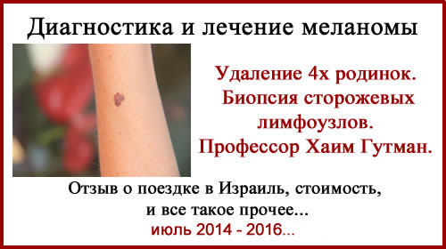 Лечение меланомы в Израиле. Биопсия сторожевых лимфоузлов