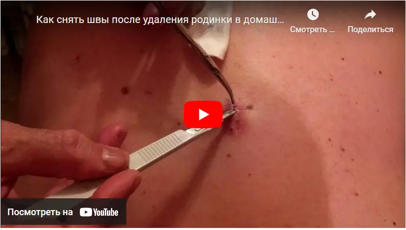 Как снять швы в домашних условиях?