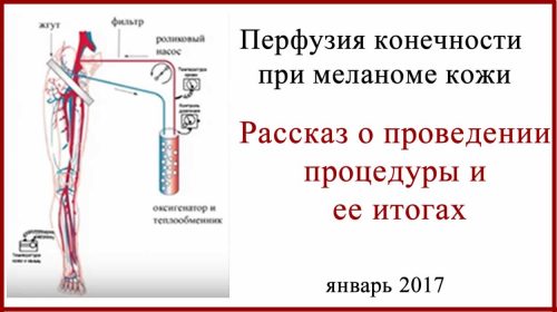 Перфузия конечностей при меланоме кожи