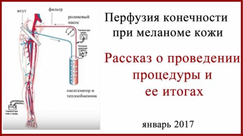 Перфузия конечностей при меланоме кожи Перфузия конечностей при меланоме кожи