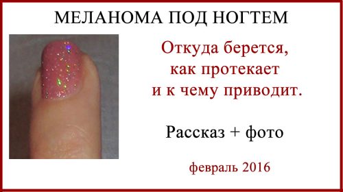 Меланома под ногтем. История, фото