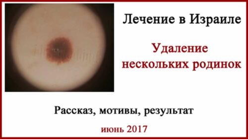 Почему люди лечатся в Израиле? Меланома in situ