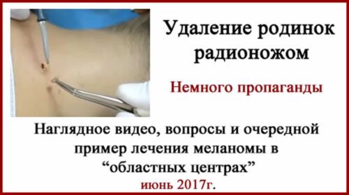 Удаление родинок радионожом. История и пропаганда