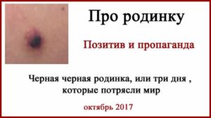 Травмированная черная родинка фото