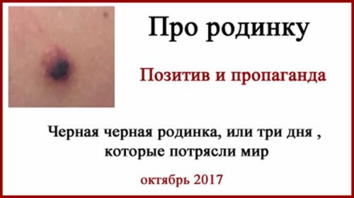 Травмированная черная родинка фото