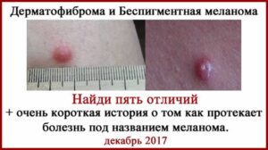 Меланома vs Дерматофиброма