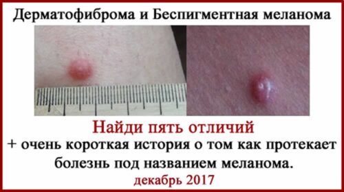 Меланома vs Дерматофиброма