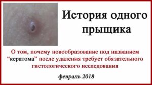 Кератома или рак? Удаление родинок лазером и БСЛУ