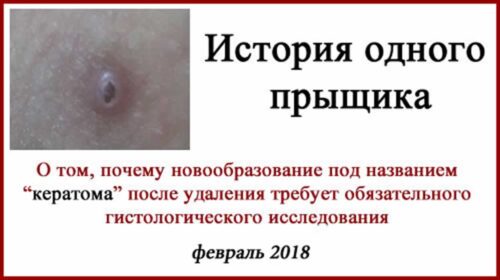 Кератома или рак? Удаление родинок лазером и БСЛУ