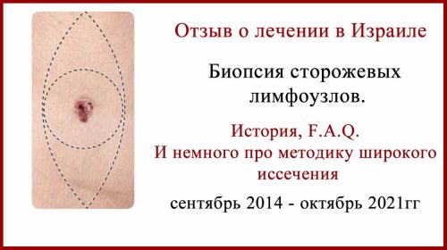 Отзыв о лечении в Израиле. Лечение меланомы