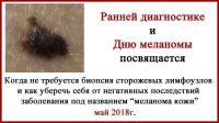 Лечение в Израиле. Удаление родинок и несостоявшаяся БСЛУ. Обновлено 16.08.20 Лечение в Израиле. Меланома