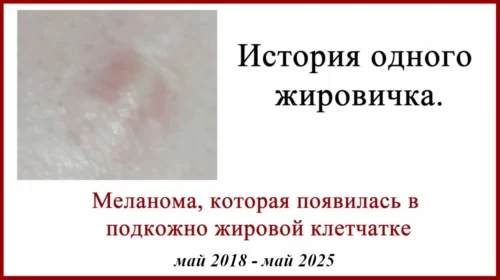 Десмопластическая меланома. Фото и история болезни