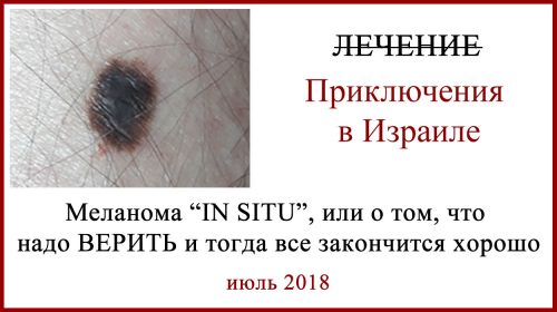Лечение в Израиле. Меланома in situ