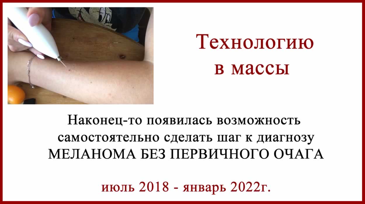 Удаление лазером. Как получить диагноз меланома без первичного очага