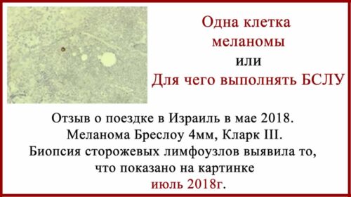 Одна клетка меланомы в сторожевом лимфоузле. Фото. Отзыв о лечение в Израиле