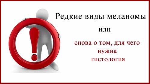 Редкие виды меланомы