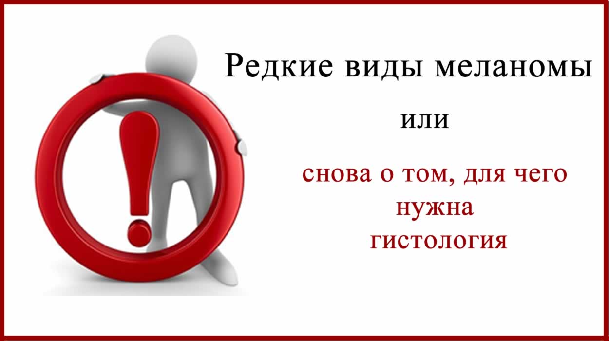 Редкие виды меланомы Редкие виды меланомы