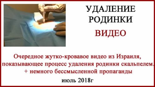 Удаление родинки скальпелем видео