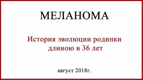 Превращение родинки в меланому