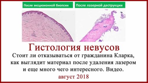 Удаление родинок лазером