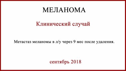 Метастаз в лимфоузел после удаления меланомы 0,5-0,7 мм