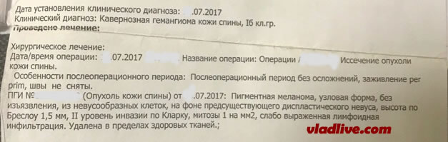 Меланома. Кларк II Меланома. Кларк II