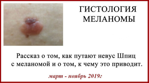 Меланома, гистология , невус Шпиц.
