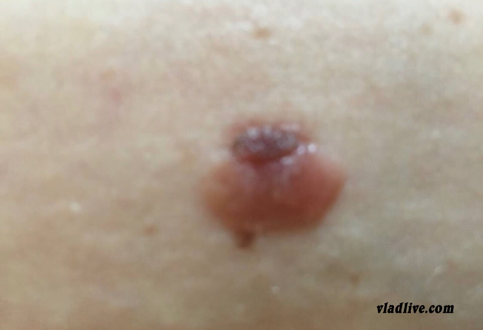 Меланома на животе Думали невус Шпиц, а оказалась меланома на животе