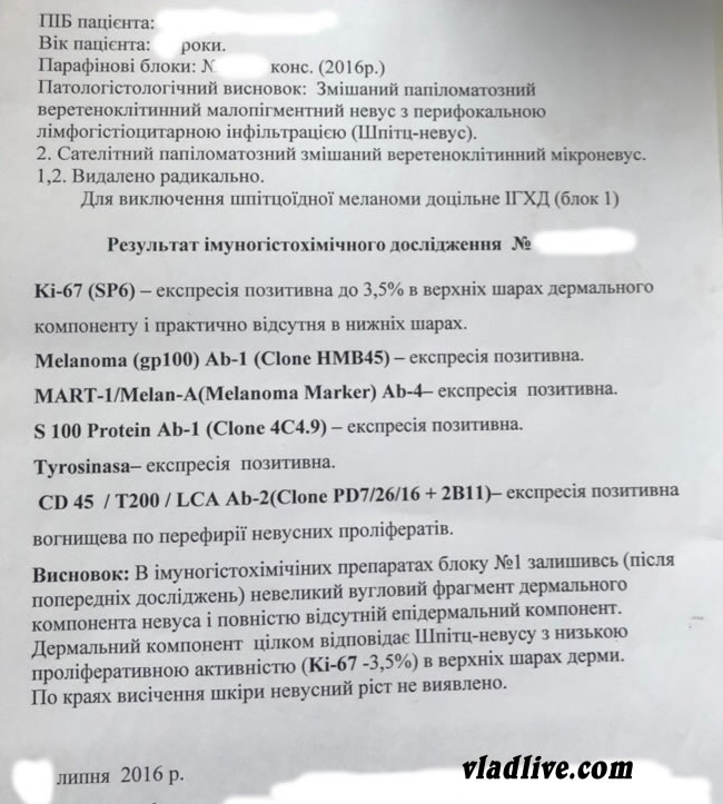 Меланома. Повторный пересмотр гистологии Меланома. Повторный пересмотр гистологии. ИГХ, которая оказалась ошибочной