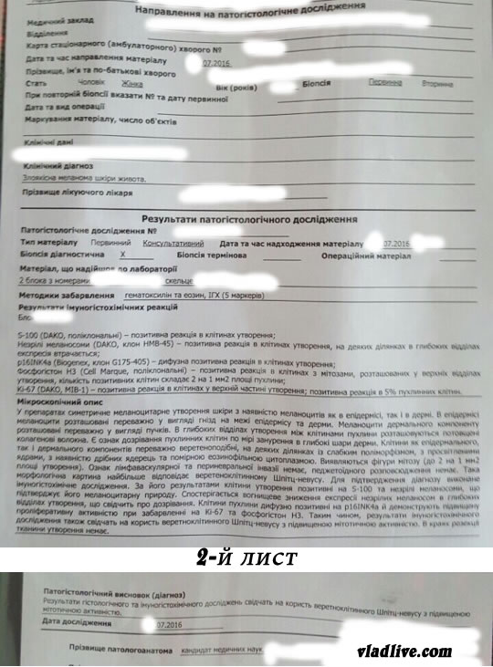 Меланома. Пересмотр гистологии Невус Шпиц. Пересмотр гистологических материалов