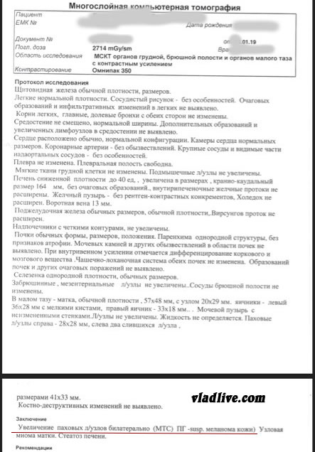 Метастазы меланомы КТ. Метастазы меланомы.