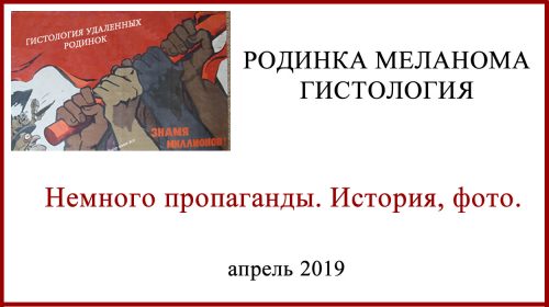 Родинка меланома гистология фото